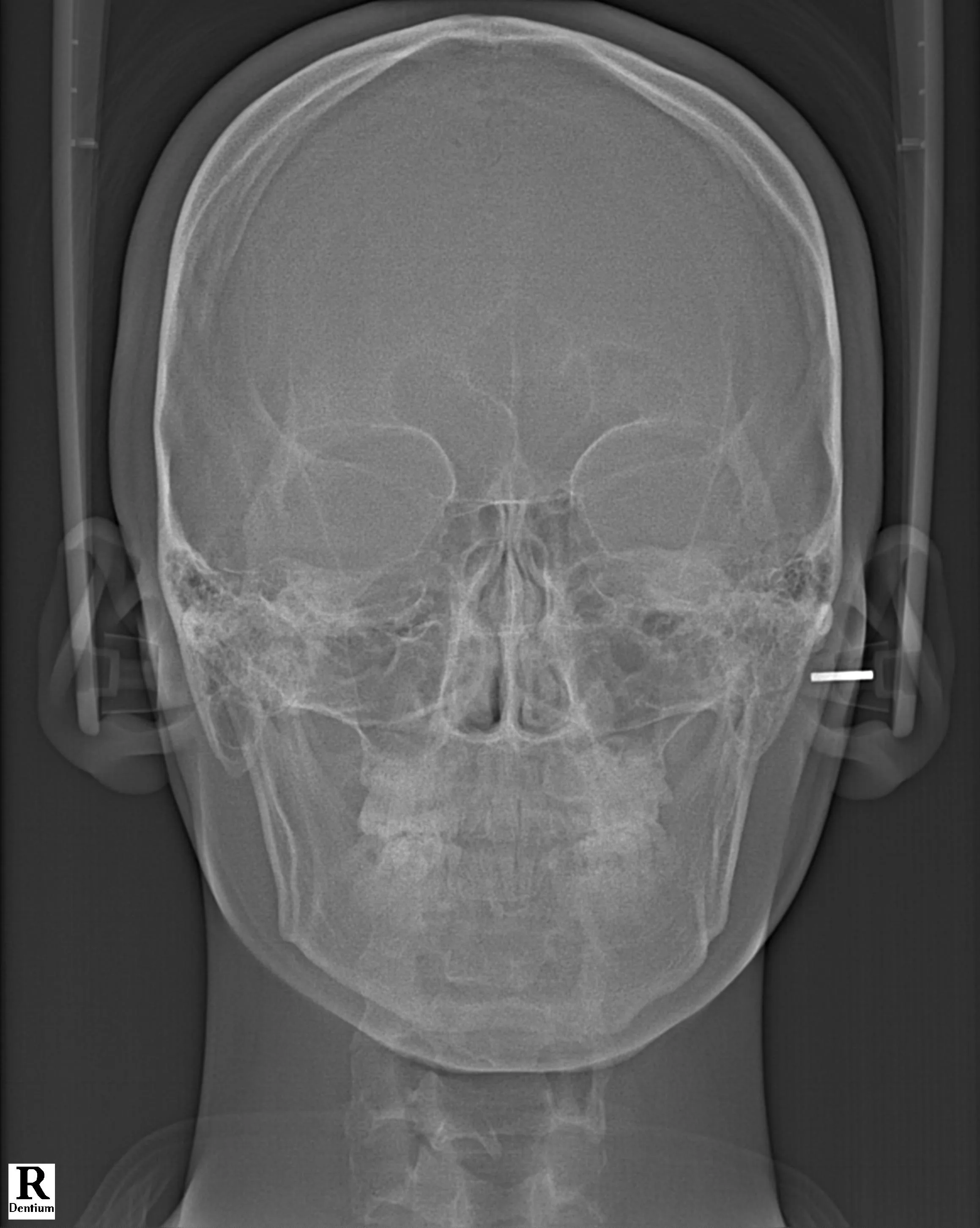 정면 두부 X-ray 이미지