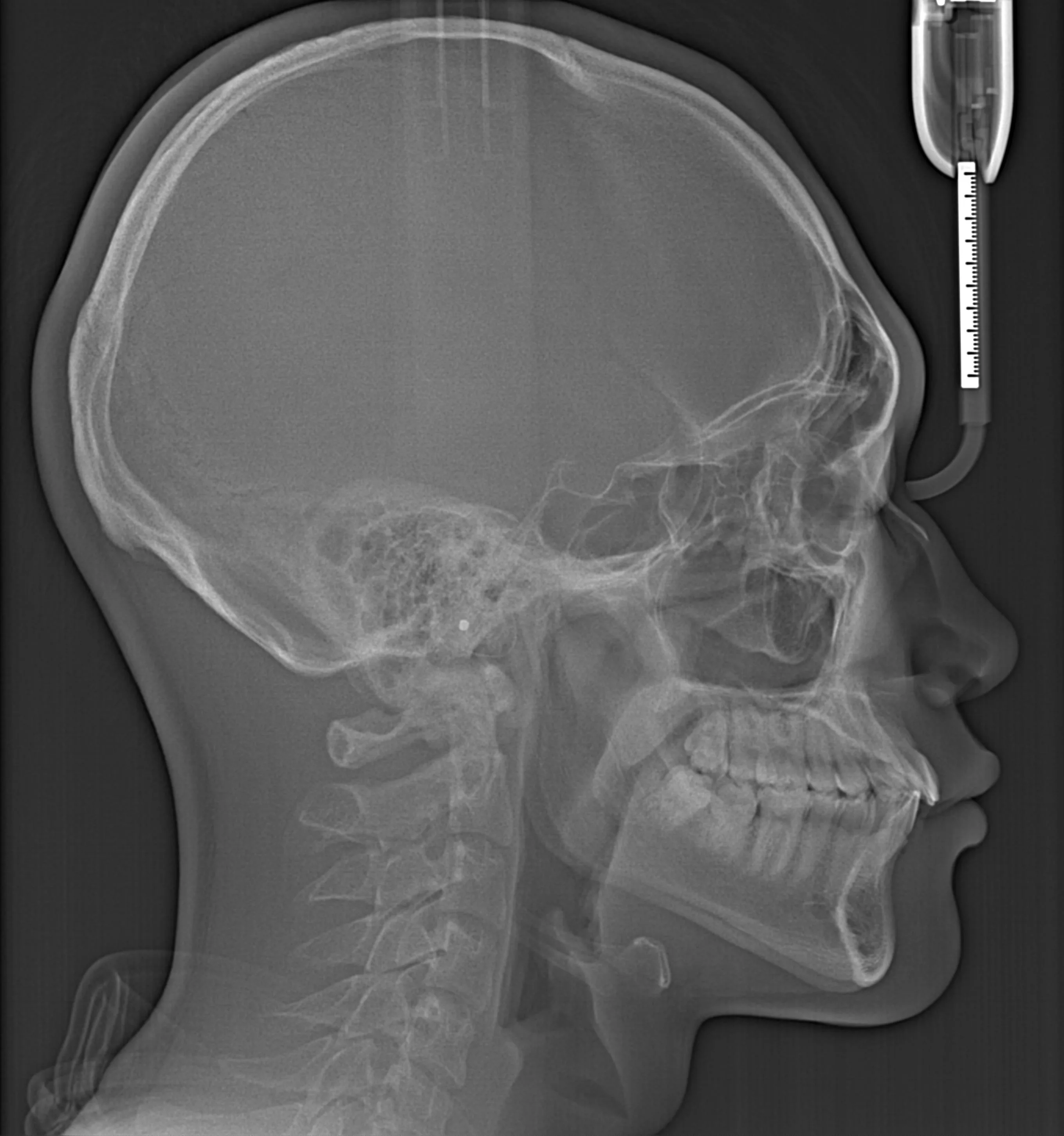 측면 두부 X-ray 이미지