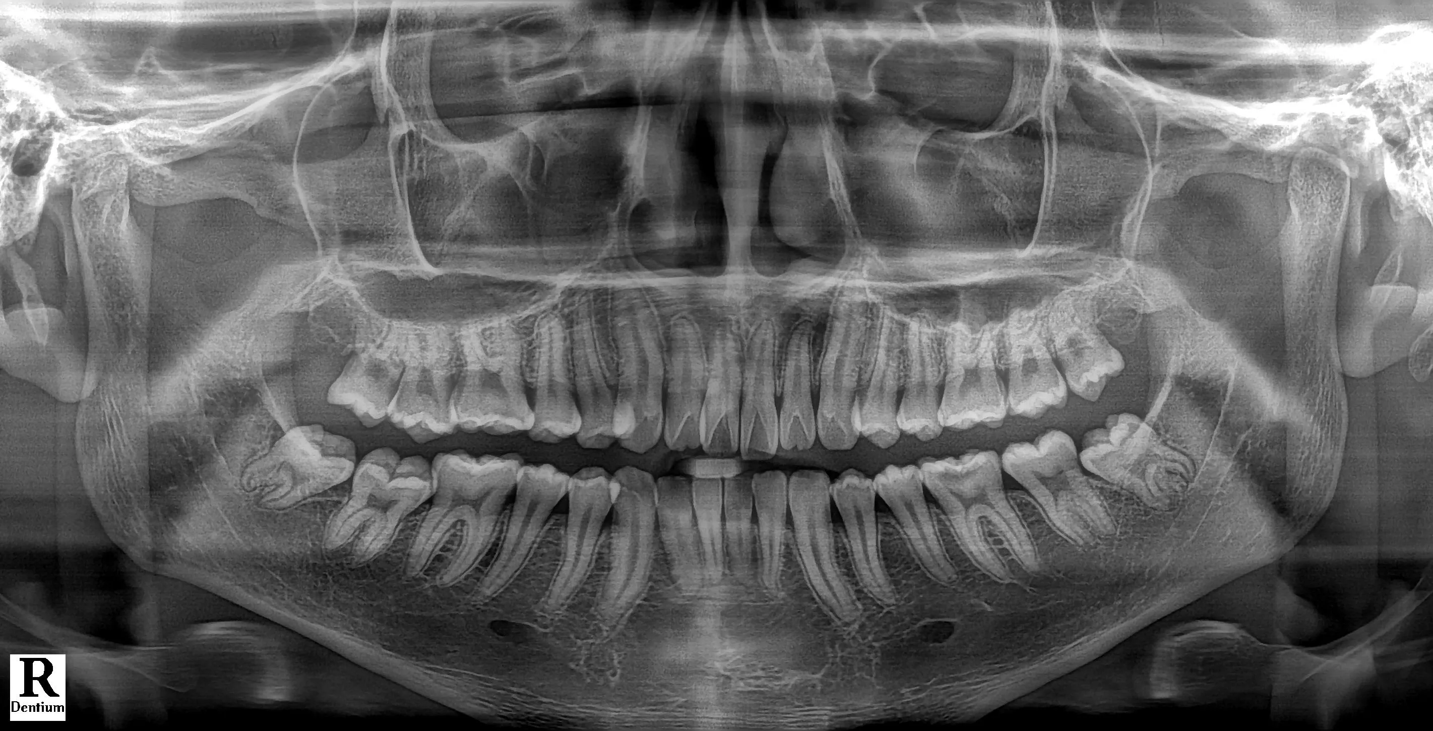 치아와 턱뼈 파노라마 X-ray 이미지