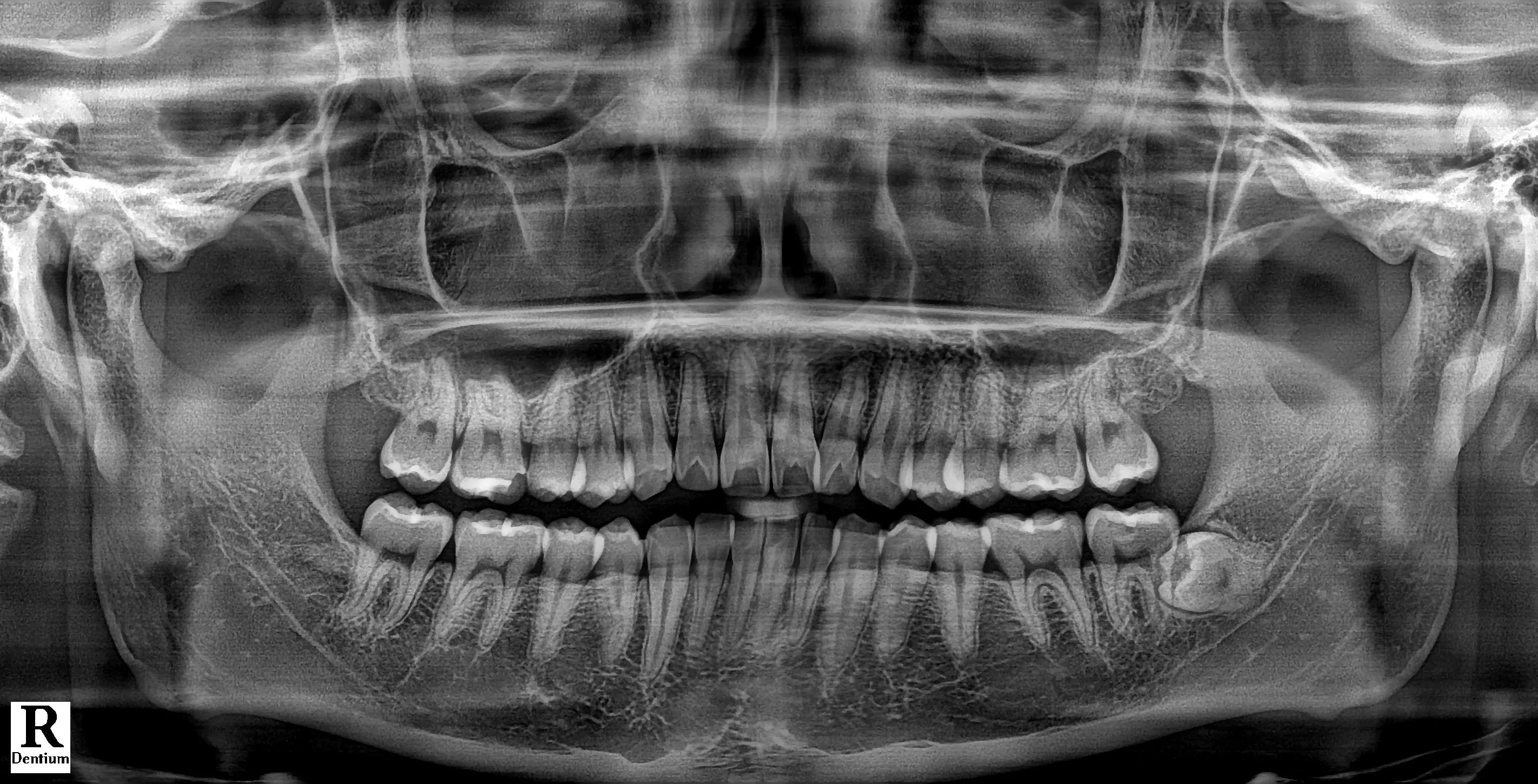 사랑니 진단 파노라마 X-ray 이미지