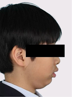어린이 교정 전 측면 사진