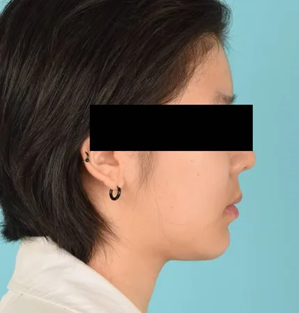 성인 교정 후
