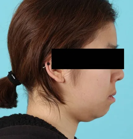 성인 교정 전