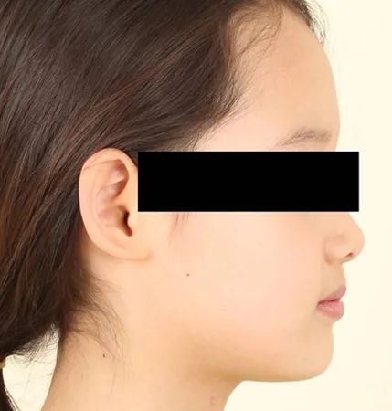 어린이 교정 후