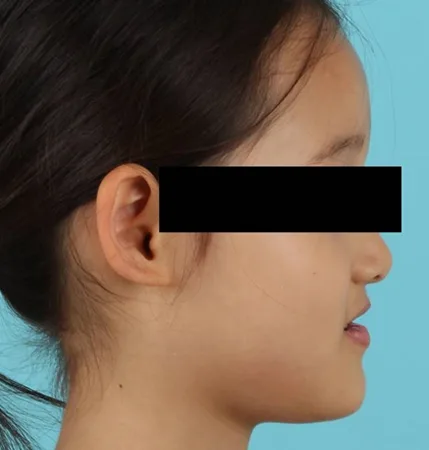어린이 교정 전
