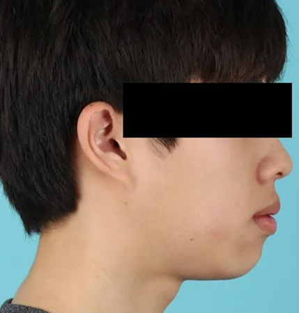 청소년 교정 전