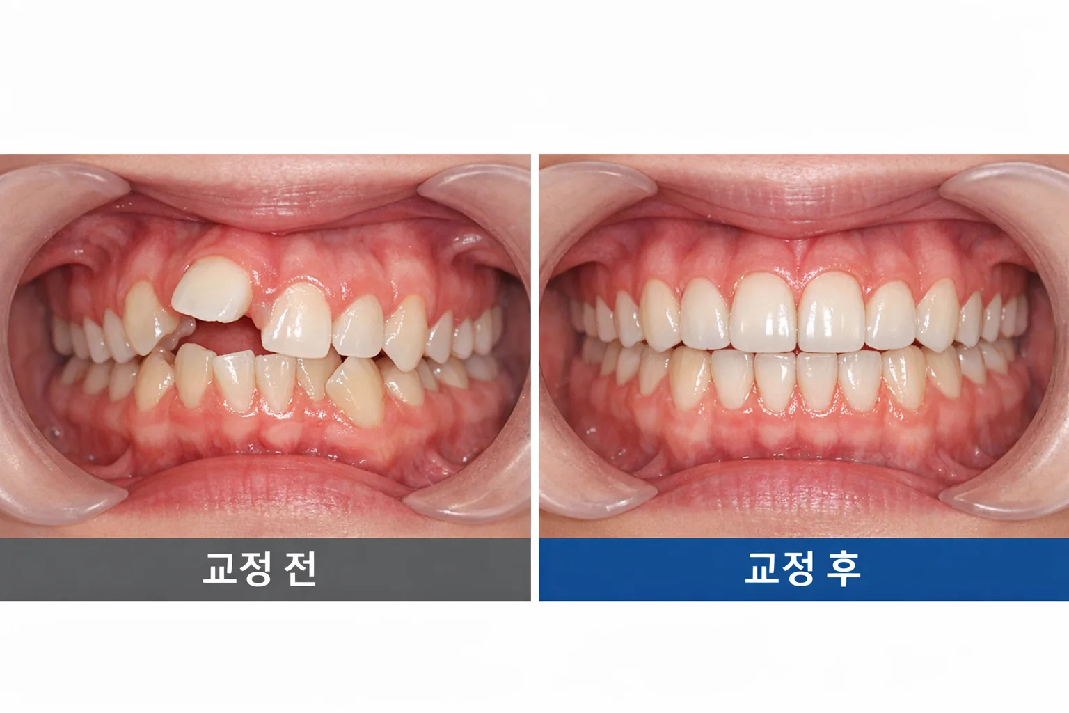 덧니 교정 전