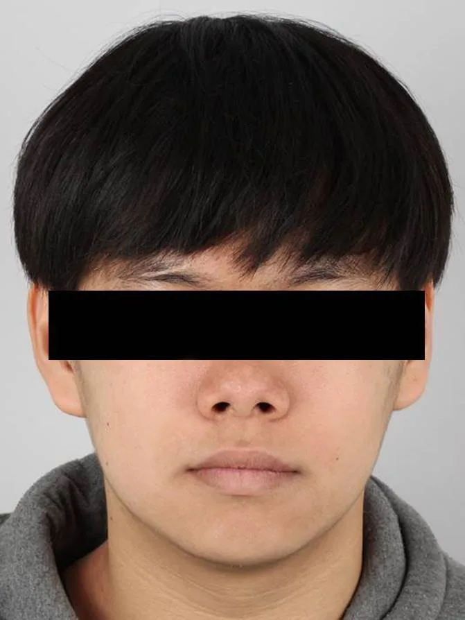 돌출입 교정 사례 치료 후 사진