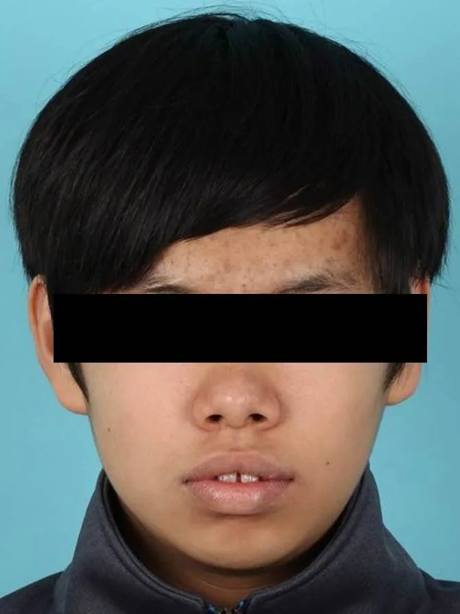 돌출입 교정 사례 치료 전 사진